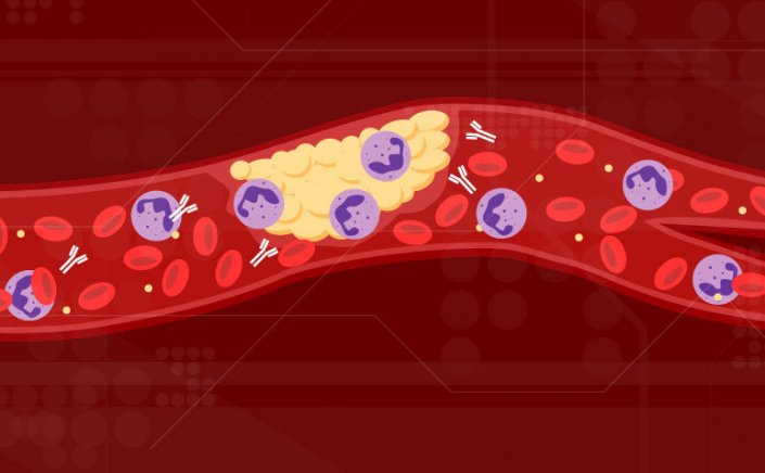 COVID-19  Blood Clots: Η επικίνδυνη φλεβική θρομβοεμβολή μπορεί να εμφανιστεί και σε ασθενείς με μέτρια Covid-19