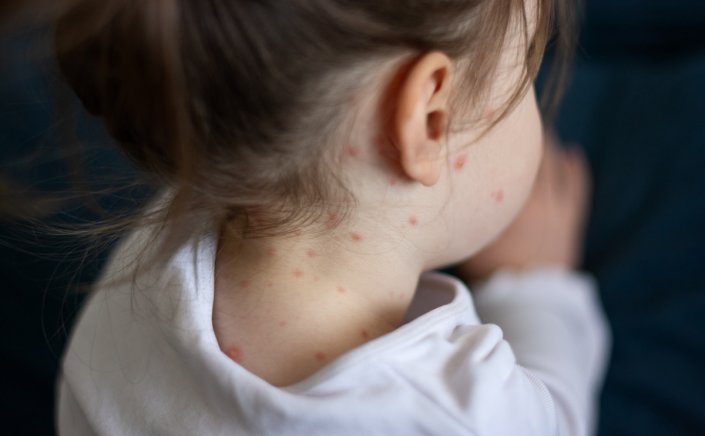 Measles: Η ιλαρά είναι πολύ χειρότερερη από τον κορωνοϊό!! Τα παιδιά πρέπει να κάνουν εμβόλιο, τονίζει η Παγώνη